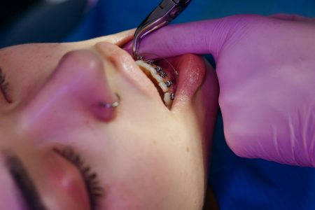 Orthodontic Therapist needed at London (Visa Sponsorship Available) A close-up view of a dental procedure involving braces on a teen.